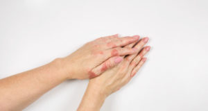 https://www.freepik.com/premium-photo/eczema-hands_6312774.htm#page=1&query=Eczema%20&position=18