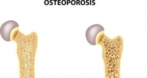 https://www.freepik.com/premium-vector/illustration-bone-hip_2579172.htm#page=1&query=osteoporosis&position=36