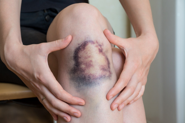 https://www.freepik.com/premium-photo/large-bruise-damage-knee-young-woman_7282907.htm#page=1&query=bruise&position=30