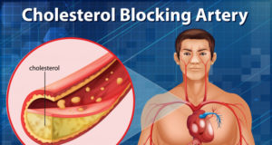 https://www.freepik.com/free-vector/diagram-showing-cholesterol-blocking-artery-human-body_8145456.htm#page=1&query=cholesterol&position=1