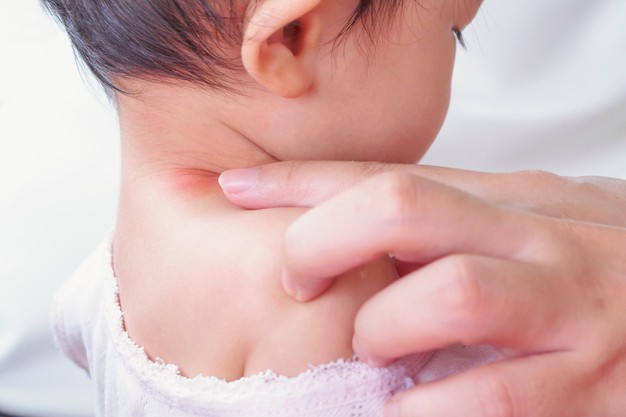 https://www.freepik.com/premium-photo/mother-applying-antiallergic-cream-baby-neck-with-skin-rash-allergy-with-red-spot-cause-by-mosquito-bite_11735236.htm?query=bug%20bites