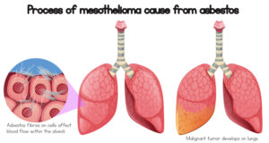 https://www.freepik.com/premium-vector/process-mesothelioma-cause-asbestos_2440347.htm#query=Mesothelioma&position=18&from_view=search