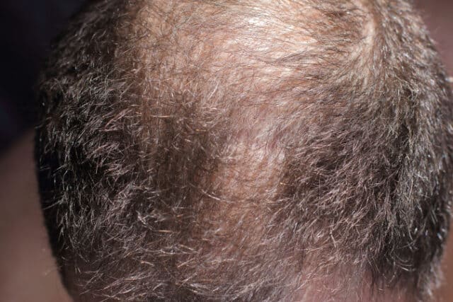 https://www.vecteezy.com/photo/2844601-hair-loss-man-scalp-baldness-closeup