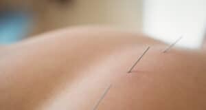 https://www.freepik.com/free-photo/close-up-patient-getting-dry-needling_8405510.htm#query=acupuncture&position=44&from_view=search