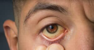 https://www.freepik.com/premium-photo/man-checking-yellow-eyes-high-bilirubin-level-cirrhosis-hepatitis-liver-disease-liver-jaundice_24110538.htm#query=bad%20liver&position=24&from_view=search