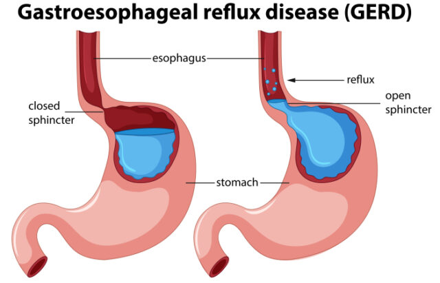 https://www.freepik.com/free-vector/gastroesophageal-reflux-disease-anatomy_2840999.htm#query=GERD&position=44&from_view=search&track=sph