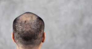 https://www.vecteezy.com/photo/12215805-bald-man-with-hair-problems