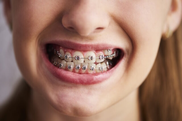 https://www.freepik.com/free-photo/shot-teeth-with-braces_15971638.htm#query=dential%20braces&position=10&from_view=search&track=ais