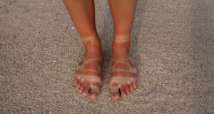 https://www.freepik.com/free-photo/view-woman-s-sunburn-feet-from-wearing-sandals-beach_40165584.htm#page=2&query=sunburn&position=5&from_view=search&track=sph